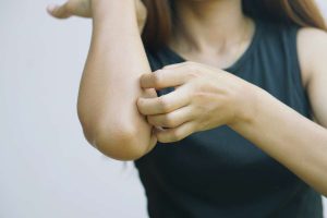 A gluténérzékenység bőrtünetei (glutén allergia kiütés)